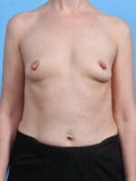Breast Augmentation - Case 28721 - Before