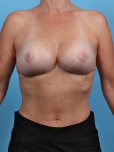 Breast Implant Revision - Case 28759 - After