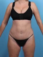 Tummy Tuck - Case 28775 - After