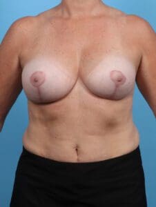 Breast Implant Revision - Case 28785 - After