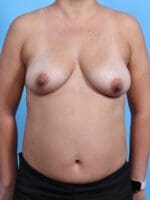 Breast Lift/Reduction with Implants - Case 28793 - Before