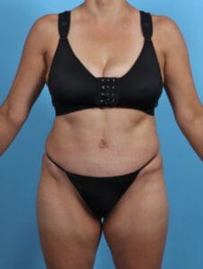 Tummy Tuck - Case 28909 - After