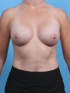 Breast Augmentation - Case 28936 - After