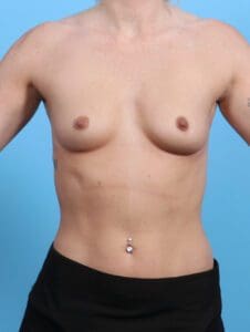 Breast Augmentation - Case 29004 - Before