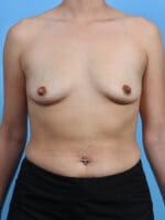 Breast Augmentation - Case 29092 - Before