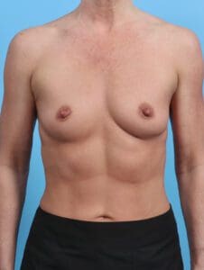 Breast Augmentation - Case 29217 - Before