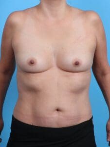Breast Augmentation - Case 29305 - Before