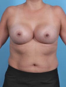 Breast Augmentation - Case 29305 - After