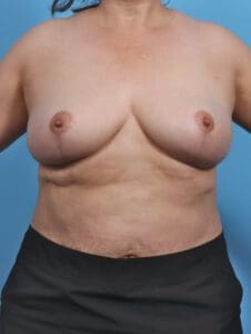 Breast Implant Removal - Case 29313 - After