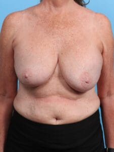 Breast Implant Revision - Case 29343 - Before