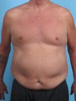 Male Tummy Tuck - Case 29361 - Before