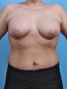Breast Augmentation - Case 29431 - After