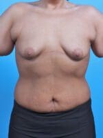 Breast Augmentation - Case 29431 - Before