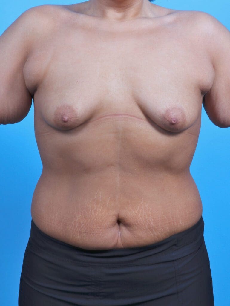 Breast Augmentation - Case 29431 - Before