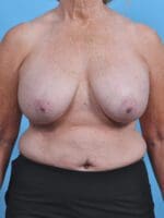 Breast Implant Revision - Case 29446 - Before
