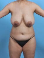 Breast Lift/Reduction w/o Implants - Case 29515 - Before
