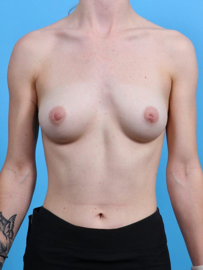 Breast Augmentation - Case 29529 - Before
