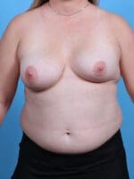 Breast Implant Revision - Case 29545 - Before