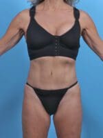 Tummy Tuck - Case 29663 - After