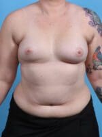 Breast Lift/Reduction with Implants - Case 29681 - Before