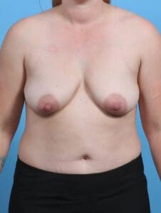 Breast Lift/Reduction with Implants - Case 29689 - Before