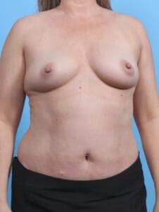 Breast Augmentation - Case 29707 - Before