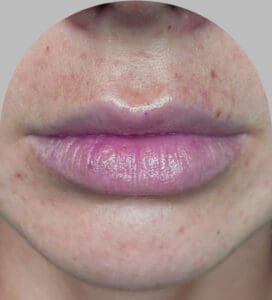 Lip Fillers - Case 29727 - Before