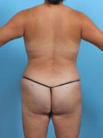 Liposuction - Case 29735 - After