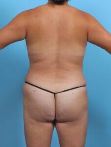 Liposuction - Case 29735 - After
