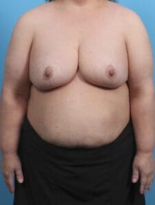 Breast Lift/Reduction w/o Implants - Case 29745 - After