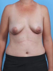 Breast Augmentation - Case 29753 - Before