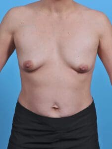 Breast Lift/Reduction with Implants - Case 29769 - Before