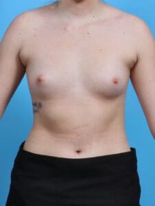 Breast Augmentation - Case 29785 - Before