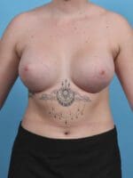 Breast Augmentation - Case 29785 - After