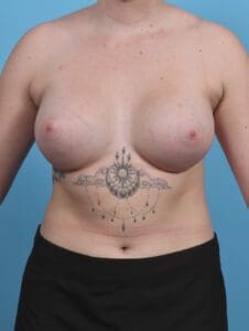 Breast Augmentation - Case 29785 - After