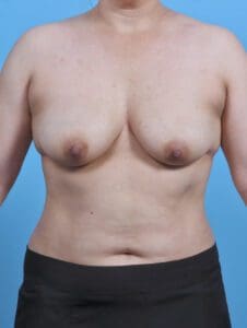 Breast Lift/Reduction with Implants - Case 29806 - Before