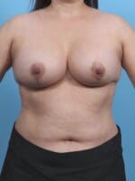 Breast Lift/Reduction with Implants - Case 29806 - After