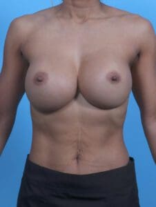 Breast Implant Revision - Case 29822 - After