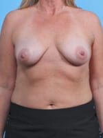Breast Lift/Reduction with Implants - Case 29854 - Before
