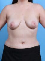 Breast Lift/Reduction with Implants - Case 29862 - Before