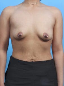 Breast Augmentation - Case 29880 - Before