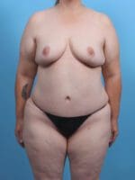 Breast Lift/Reduction w/o Implants - Case 29898 - After