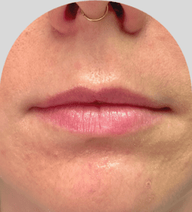 Lip Fillers - Case 29968 - Before