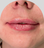 Lip Fillers - Case 29968 - After