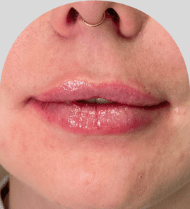 Lip Fillers - Case 29968 - After