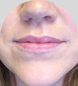 Lip Fillers - Case 30032 - Before