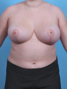 Breast Lift/Reduction w/o Implants - Case 30063 - After
