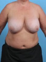 Breast Implant Removal - Case 30139 - Before