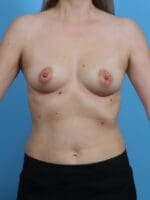 Breast Augmentation - Case 30079 - Before