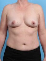 Breast Augmentation - Case 30104 - Before